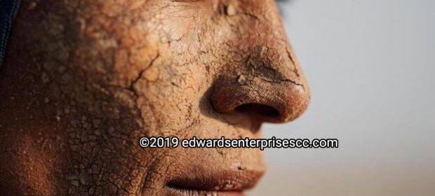 A person with very dry skin